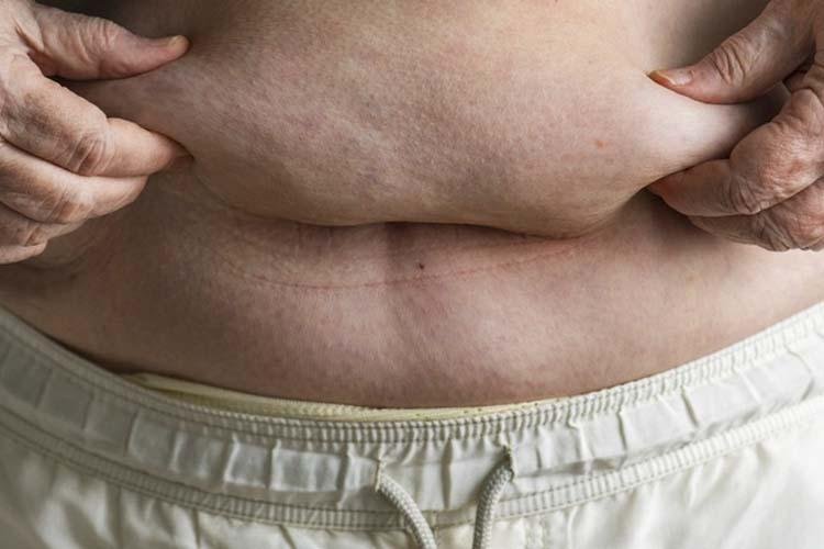 Bariátrica pode reduzir risco de câncer de mama em mulheres obesas