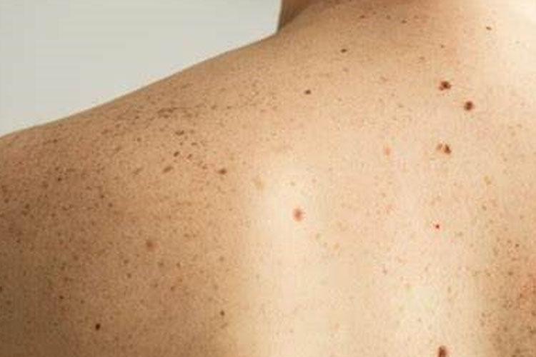 Câncer de pele: como prevenir a doença causada pelo excesso de sol