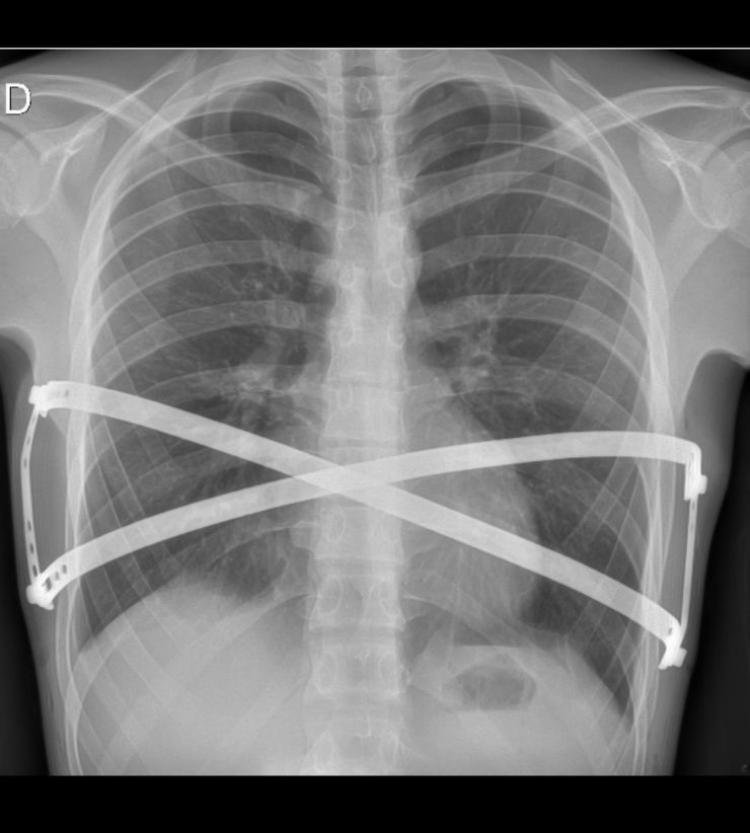 Médicos brasileiros desenvolvem novo material para cirurgia torácica