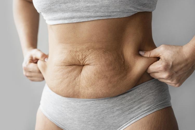 Para quem é indicado a abdominoplastia?