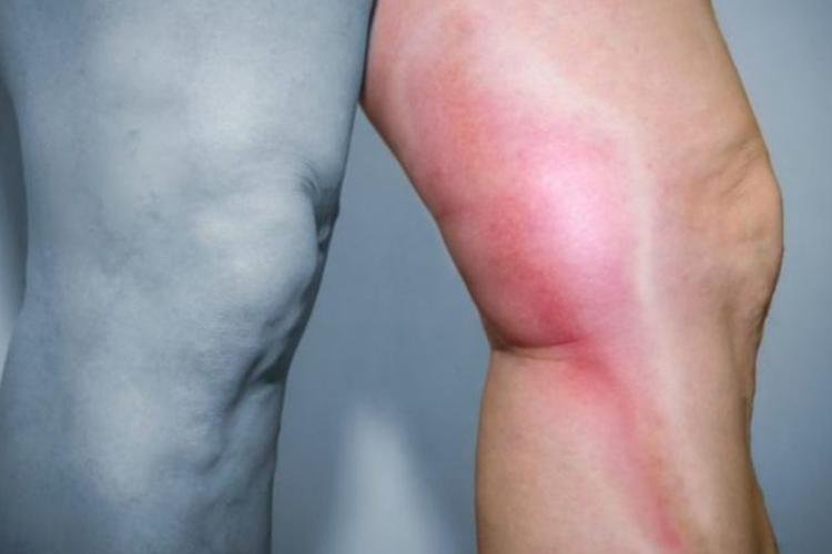 Embora tenha prevenção, trombose venosa ainda acomete 884 pessoas por ano no Norte, aponta sociedade médica