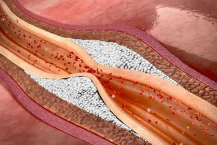 Vitamina K2 tem papel de destaque na prevenção e controle da calcificação arterial