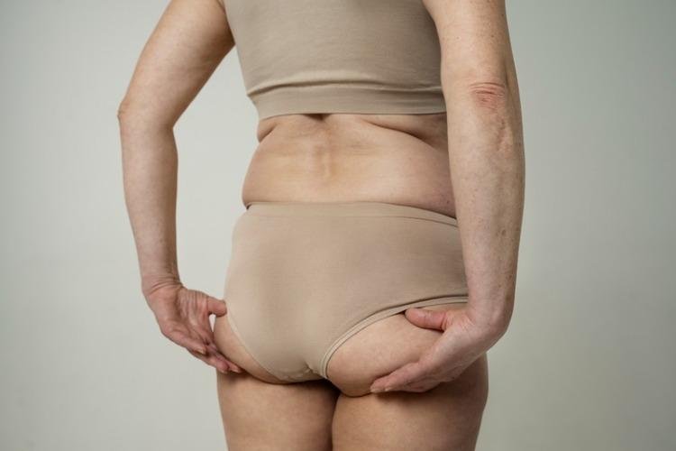 "Bumbum sanfona": recuperar o peso devolve o mesmo contorno dos glúteos?