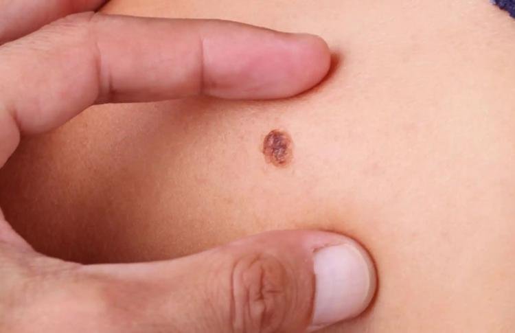 Cuidados simples podem ajudar a reduzir incidência de câncer de pele