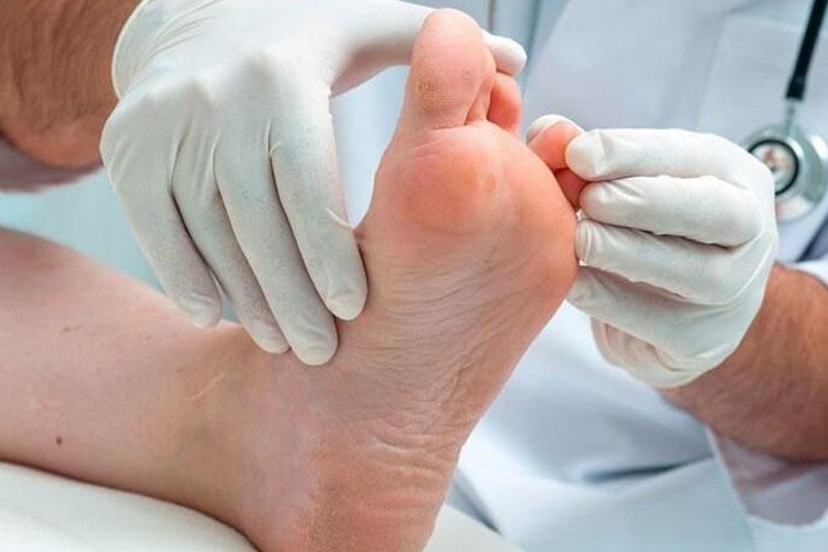 Estudo revela potencial cicatrizante do extrato de sucupira branca em úlceras crônicas de pacientes diabéticos