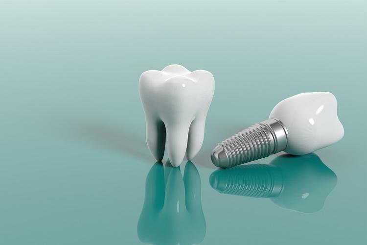 Veja o que é fato ou fake sobre implantes dentários