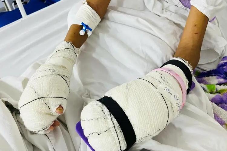 Cresce número de atendimentos no Centro de Tratamento de Queimados do Hospital de Emergência, em Macapá