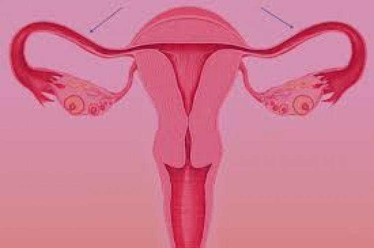 Saúde das trompas: entenda a hidrossalpinge, obstrução que pode causar infertilidade