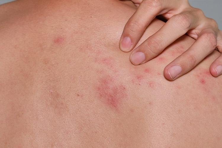 Herpes sem crise: como prevenir e tratar