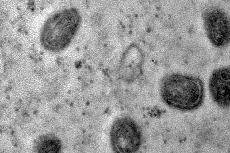 Segunda morte pela Monkeypox é confirmada no Rio de Janeiro