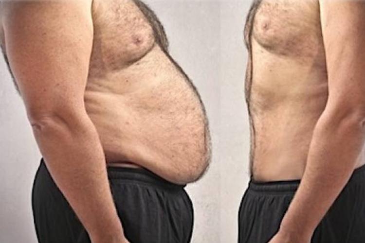Abdominoplastia Masculina: Cada vez mais procurada pelos homens