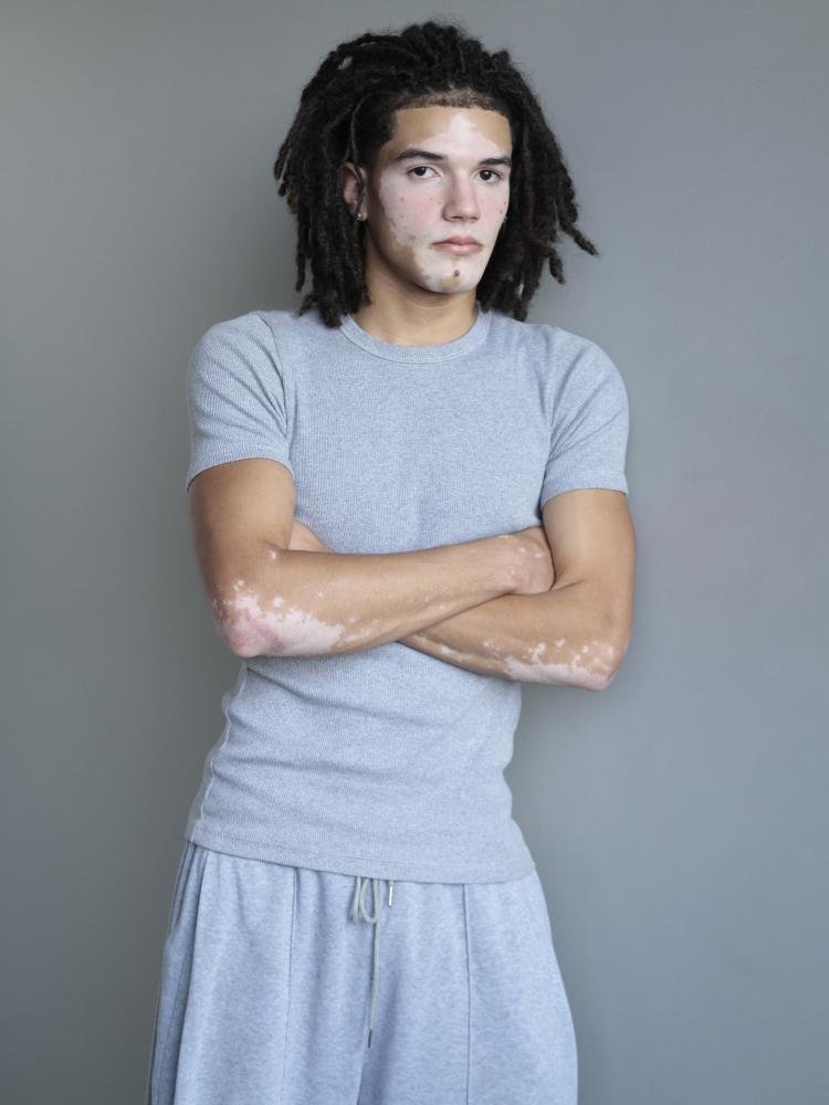 Sugestão: jovem com vitiligo quebra barreiras e desponta como modelo